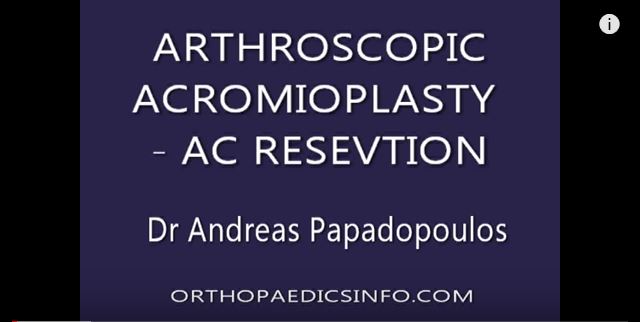 Shoulder Acromioplasty and AC resection - ΑΚΡΩΜΙΟΠΛΑΣΤΙΚΗ ΚΑΙ ΑΦΑΙΡΕΣΗ ΠΕΡΙΦΕΡΙΚΟΥ ΑΚΡΟΥ ΚΛΕΙΔΑΣ