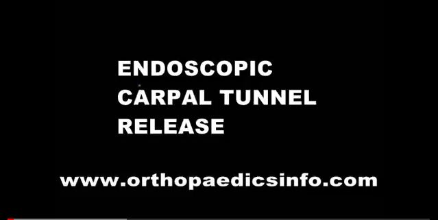 Endoscopic carpal tunnel release - ενδοσκοπική διάνοιξη καρπιαίου σωλήνα