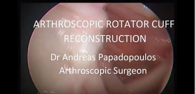 Artrhoscopic reconstruction of massive rotator cuff tear. Dr Andreas Papadopoulos, Olympion Patras