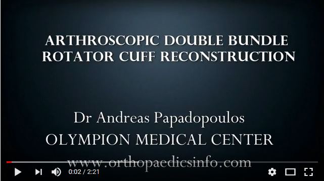Arthroscopic, double row, rotator cuff reconstruction