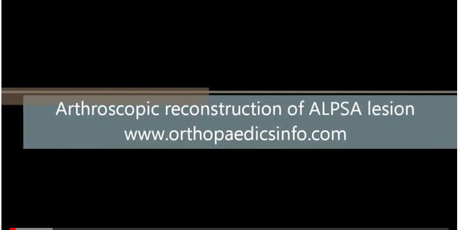 Arthroscopic reconstruction of shoulder instability - Αστάθεια ώμου - orthopaedicsinfo.com