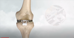 Ολική αρθροπλαστική γόνατος με ρομποτικό σύστημα NAVIO